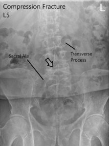 Radiografía de la columna vertebral LS en AP y vistas laterales que muestran fractura por compresión significativa L5 