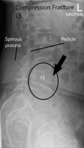 Radiografía de la columna vertebral LS en AP y vistas laterales que muestran fractura por compresión significativa L5 2