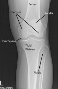 Radiografía de la rodilla en AP y vista del horizonte