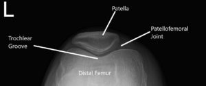 Radiografía de la rodilla en AP y vista del horizonte 2