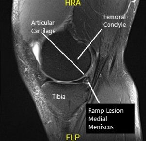 Resonancia magnética de la rodilla en la sección sagital y coronal