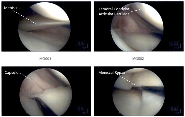 Imágenes artroscópicas intraoperatorias de la rodilla derecha
