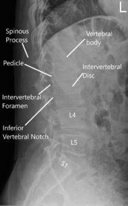 LS Spine X-ray en AP y vistas laterales 2