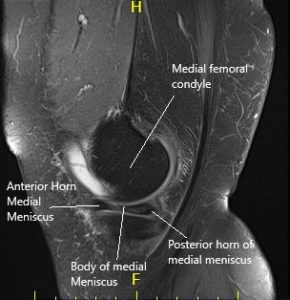 Resonancia magnética de la rodilla izquierda en secciones sagital y coronal 2
