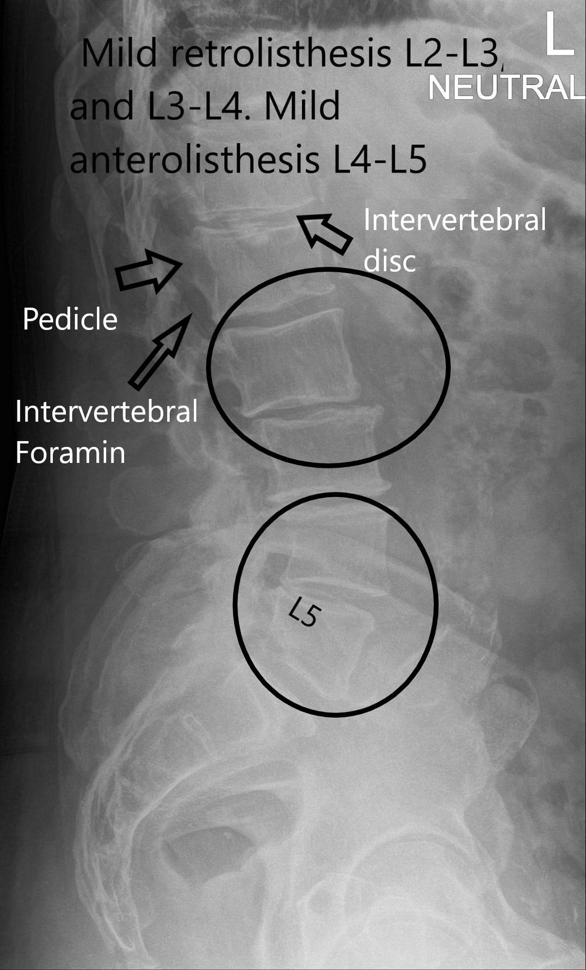 Radiografía Vista lateral de la columna vertebral LS