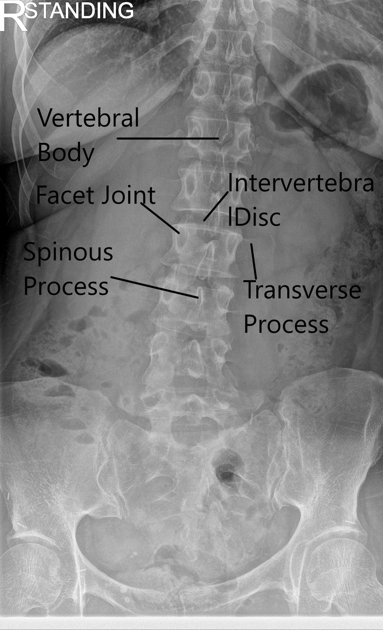 Radiografía de la columna vertebral LS en AP y vistas laterales que muestran cambios degenerativos 