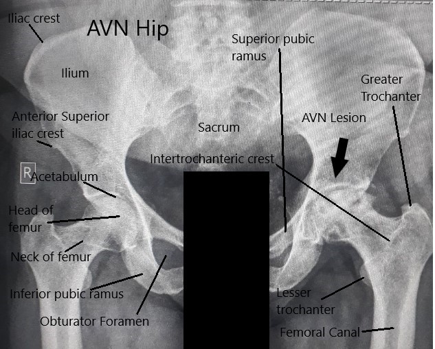 Radiografía de ambas articulaciones de la cadera que muestra AVN de la cadera izquierda