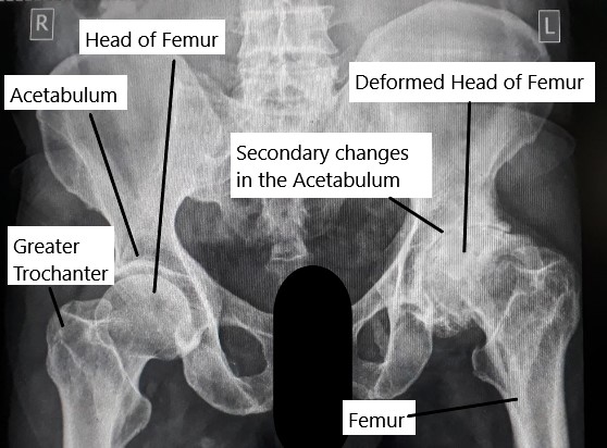 RadiografÃa que muestra necrosis avascular (AVN) de la cadera