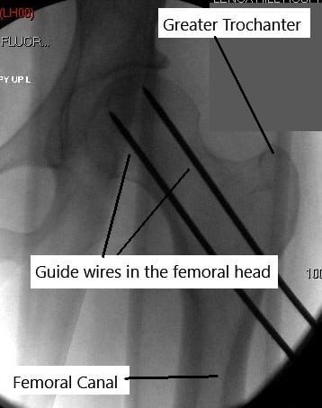 Los cables guía pasan a la cabeza femoral.