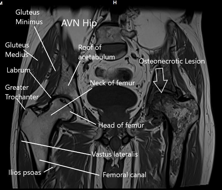 Resonancia magnética de las articulaciones de la cadera en la sección coronal Resonancia magnética de las articulaciones de la cadera en la sección coronal