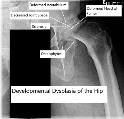 Desarrollar displasia mental