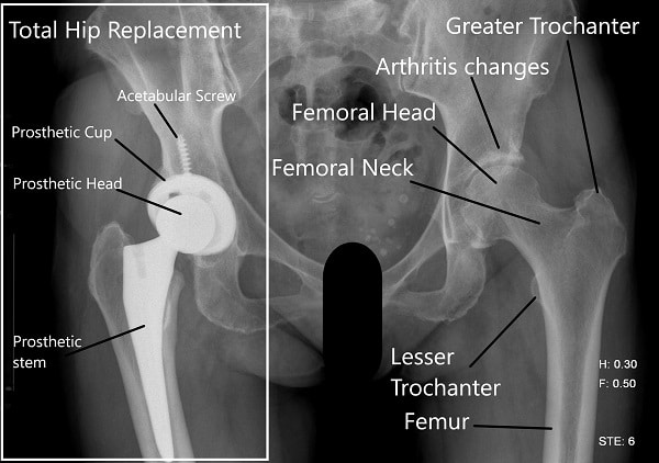 Hip x-ray