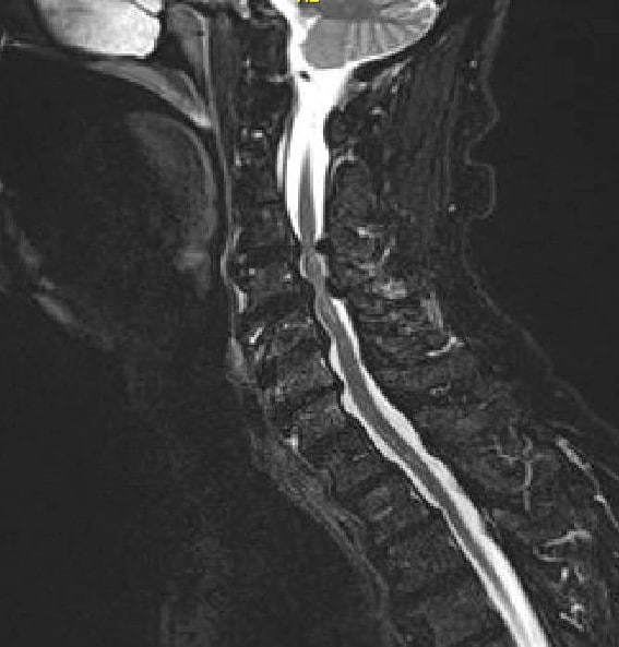 Imagen de resonancia magnética T2 Corte sagital medio que muestra estenosis y compresión graves de la médula espinal en C3-4 y C 5-6 con enfermedad articular degenerativa de la columna cervical Imagen de resonancia magnética T2 Corte sagital medio que muestra estenosis y compresión graves de la médula espinal en C3-4 y C 5-6 con enfermedad articular degenerativa de la columna cervical