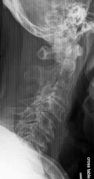 RadiografÃas Vista lateral de la columna C que muestra enfermedad degenerativa avanzada de la columna cervical RadiografÃas Vista lateral de la columna C que muestra enfermedad degenerativa avanzada de la columna cervical