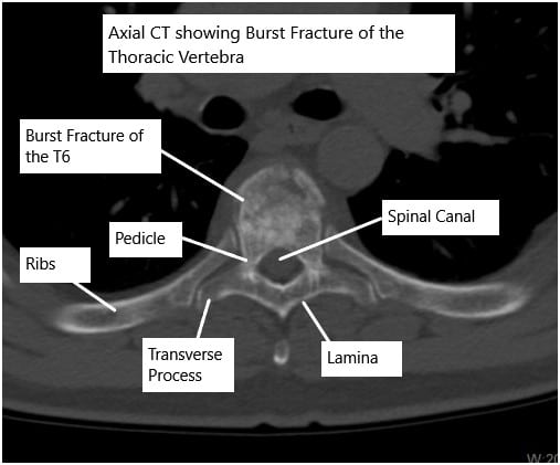 TomografÃa computarizada de la columna torácica que muestra una fractura por estallido de la vértebra T6 TomografÃa computarizada de la columna torácica que muestra una fractura por estallido de la vértebra T6