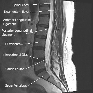 Resonancia magnética de la columna lumbar en la sección sagital que muestra cauda equina (cola de caballo) Resonancia magnética de la columna lumbar en la sección sagital que muestra cauda equina (cola de caballo)