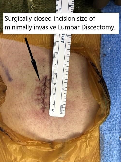 Imagen intraoperatoria que muestra el tamaño de la incisión quirúrgica de la discectomÃa lumbar mÃnimamente invasiva. Imagen intraoperatoria que muestra el tamaño de la incisión quirúrgica de la discectomÃa lumbar mÃnimamente invasiva.