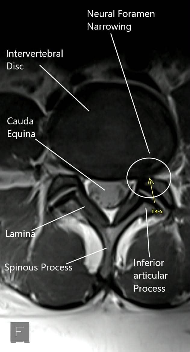 Resonancia magnética que muestra la sección axial de la columna lumbar con estrechamiento del foramen neural. Resonancia magnética que muestra la sección axial de la columna lumbar con estrechamiento del foramen neural.