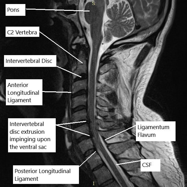 Resonancia magnética de la columna cervical en la sección sagital. Resonancia magnética de la columna cervical en la sección sagital.