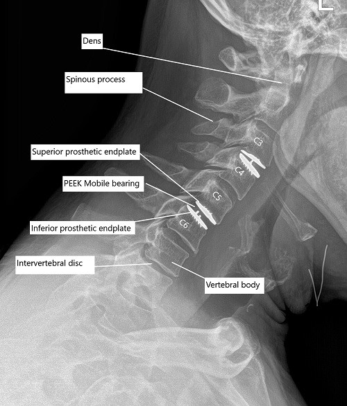 RadiografÃa postoperatoria de la columna cervical que muestra reemplazo total de disco cervical a nivel C3-C4 y C5-C6. RadiografÃa postoperatoria de la columna cervical que muestra reemplazo total de disco cervical a nivel C3-C4 y C5-C6.