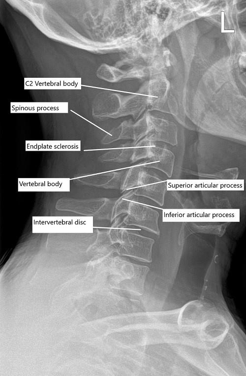 RadiografÃa preoperatoria de la columna cervical en vista lateral. RadiografÃa preoperatoria de la columna cervical en vista lateral.