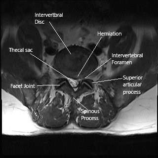 Sección axial de resonancia magnética de la columna lumbar que muestra estenosis foraminal. Sección axial de resonancia magnética de la columna lumbar que muestra estenosis foraminal.