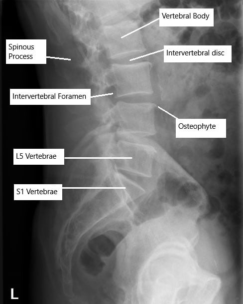 RadiografÃa de la columna lumbar que muestra cambios degenerativos. RadiografÃa de la columna lumbar que muestra cambios degenerativos.