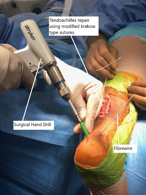 Imagen intraoperatoria que muestra la reparación del tendón de Aquiles. Imagen intraoperatoria que muestra la reparación del tendón de Aquiles.