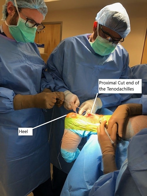 Cuadro intraoperatorio de la reparación de Tendoachilles. Cuadro intraoperatorio de la reparación de Tendoachilles.