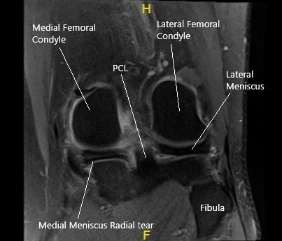Resonancia magnética de la rodilla izquierda en la sección coronal que muestra el menisco medial desgarrado. Resonancia magnética de la rodilla izquierda en la sección coronal que muestra el menisco medial desgarrado.