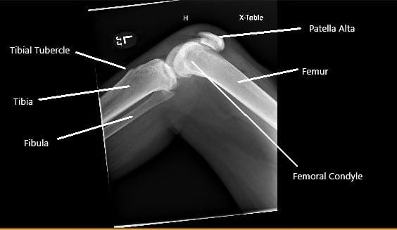 RadiografÃa de la rodilla derecha que muestra rótula alta secundaria a la rotura del tendón rotuliano. RadiografÃa de la rodilla derecha que muestra rótula alta secundaria a la rotura del tendón rotuliano.