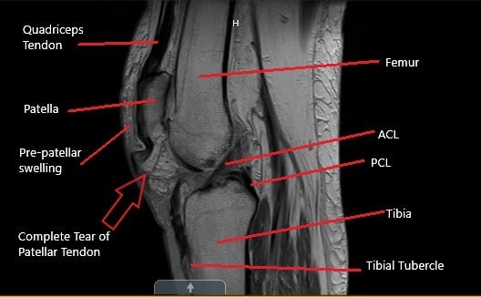 Resonancia magnética de la rodilla en la sección sagital que muestra un desgarro completo del tendón rotuliano. Resonancia magnética de la rodilla en la sección sagital que muestra un desgarro completo del tendón rotuliano.