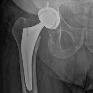 hip-xray