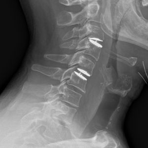 spine-xray