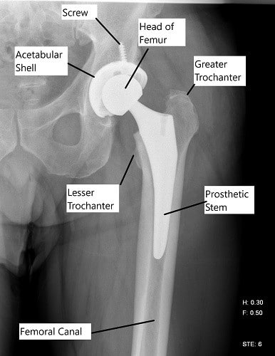 RadiografÃa que muestra un reemplazo total de cadera. RadiografÃa que muestra un reemplazo total de cadera.