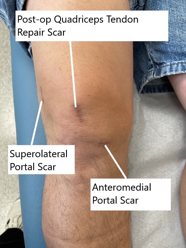 Postoperative images showing quadriceps tendon autograft scar and range of motion.