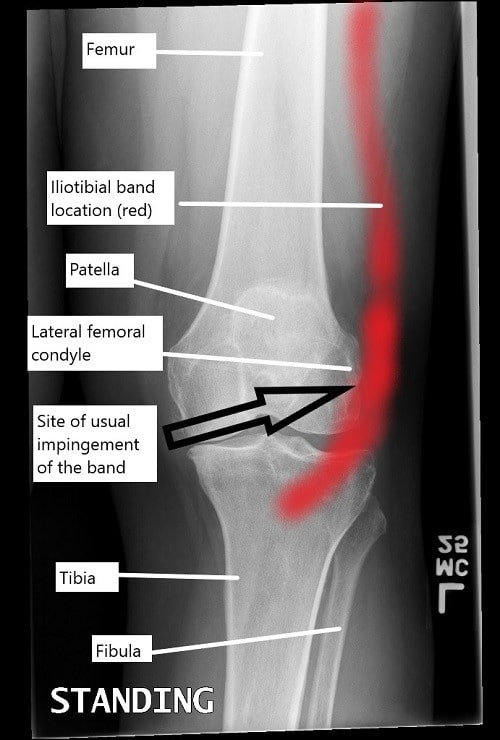 Una radiografÃa de rodilla que ilustra la ubicación de la banda iliotibial y el sitio habitual de pinzamiento. Una radiografÃa de rodilla que ilustra la ubicación de la banda iliotibial y el sitio habitual de pinzamiento.