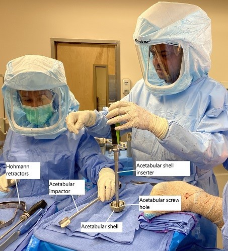 Imagen intraoperatoria que muestra la carga de la cáscara acetabular protésica. Imagen intraoperatoria que muestra la carga de la cáscara acetabular protésica.