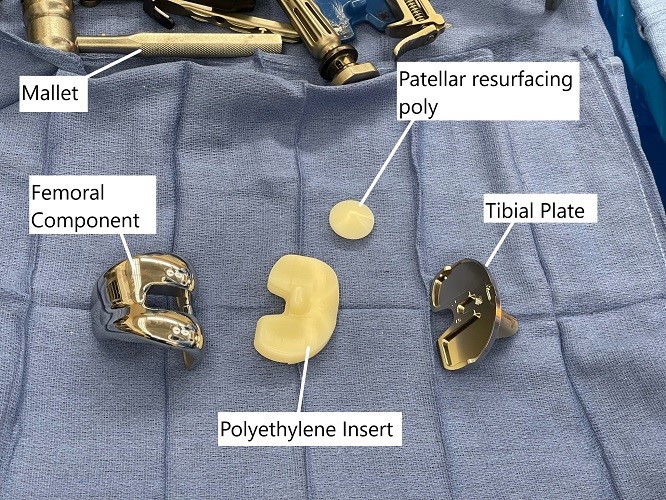 Imagen intraoperatoria que muestra los implantes utilizados en una cirugÃa de reemplazo total de rodilla. Imagen intraoperatoria que muestra los implantes utilizados en una cirugÃa de reemplazo total de rodilla.