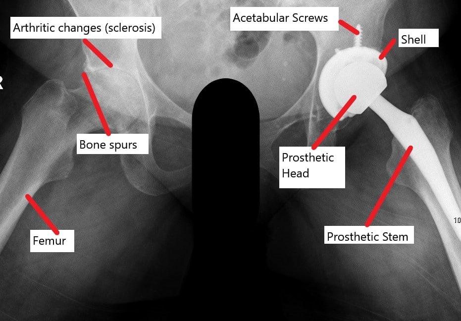 RadiografÃa que muestra una prótesis total de cadera con una articulación artrósica contralateral. RadiografÃa que muestra una prótesis total de cadera con una articulación artrósica contralateral.
