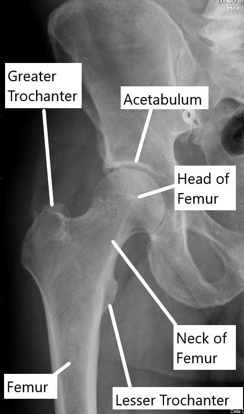 RadiografÃa que muestra la anatomÃa normal de la articulación de la cadera. RadiografÃa que muestra la anatomÃa normal de la articulación de la cadera.