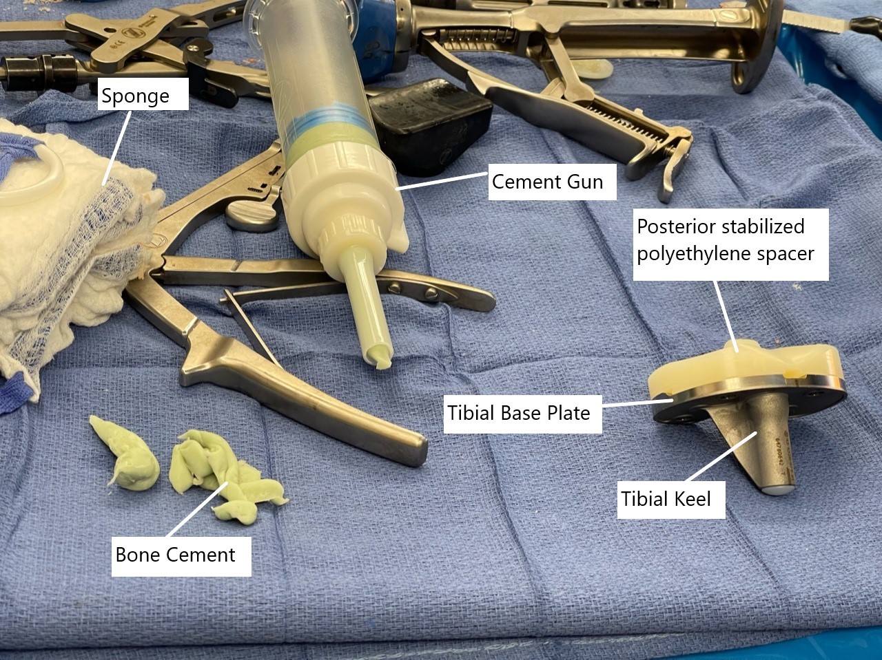 Imagen intraoperatoria que muestra el componente tibial con espaciador de polietileno. Imagen intraoperatoria que muestra el componente tibial con espaciador de polietileno.