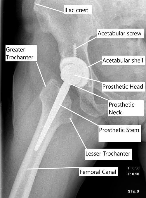 RadiografÃa que muestra una vista lateral de un reemplazo total de cadera. RadiografÃa que muestra una vista lateral de un reemplazo total de cadera.