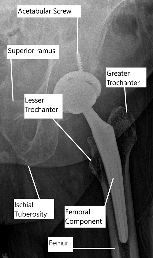 RadiografÃa que muestra un reemplazo total de cadera. RadiografÃa que muestra un reemplazo total de cadera.