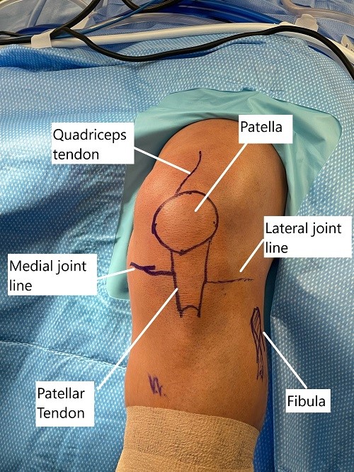 Marcas cutáneas intraoperatorias de la articulación de la rodilla antes de la reconstrucción artroscópica. Marcas cutáneas intraoperatorias de la articulación de la rodilla antes de la reconstrucción artroscópica.