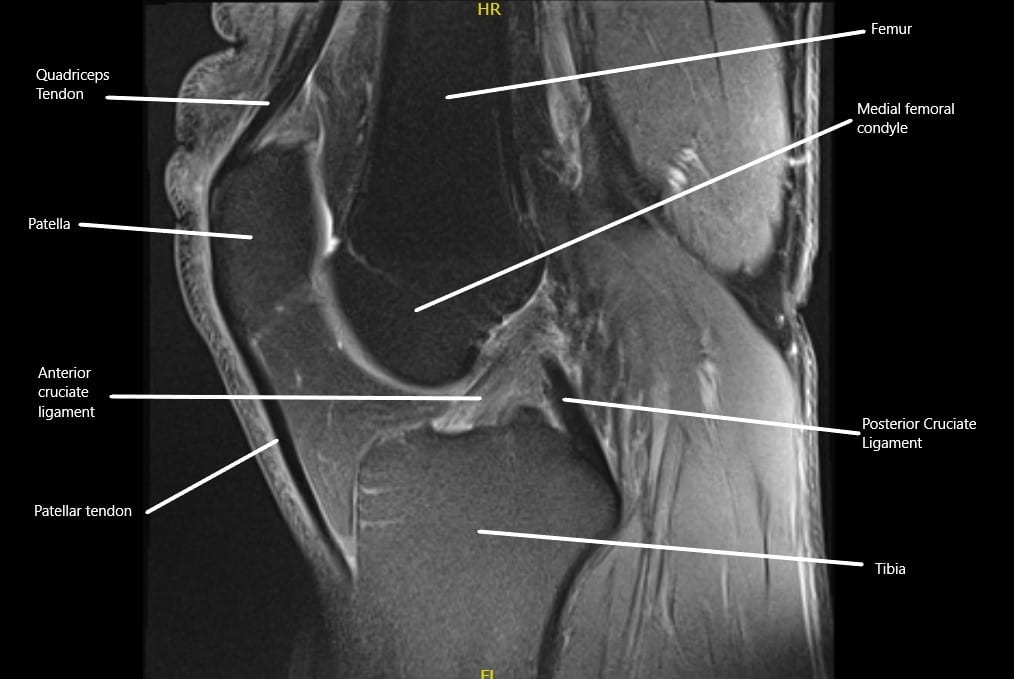 Resonancia magnética que muestra los ligamentos cruzados normales en la articulación de la rodilla en la sección sagital. Resonancia magnética que muestra los ligamentos cruzados normales en la articulación de la rodilla en la sección sagital.