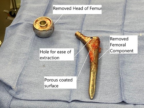 Se extrajo la cabeza del fémur y el componente femoral durante la cirugÃa de revisión. Se extrajo la cabeza del fémur y el componente femoral durante la cirugÃa de revisión.