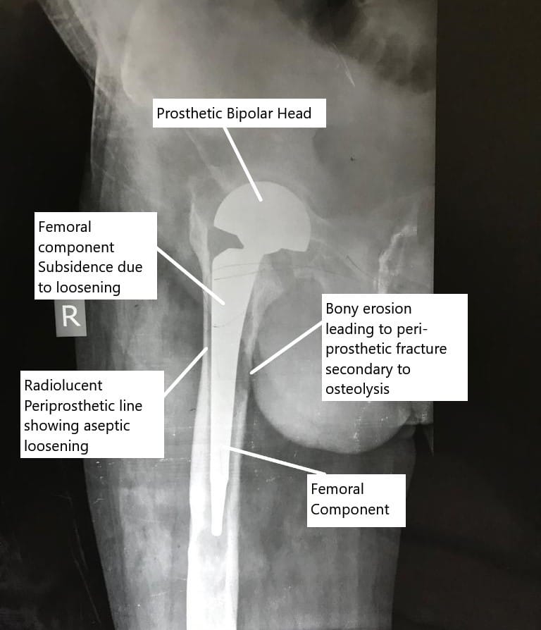 RadiografÃa que muestra aflojamiento aséptico del reemplazo de cadera. RadiografÃa que muestra aflojamiento aséptico del reemplazo de cadera.