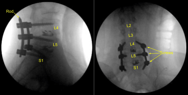 Spinal Fusion graph (2)