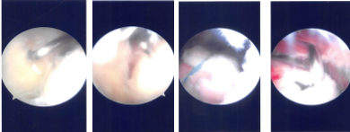 Imágenes de artroscopia intraoperatoria